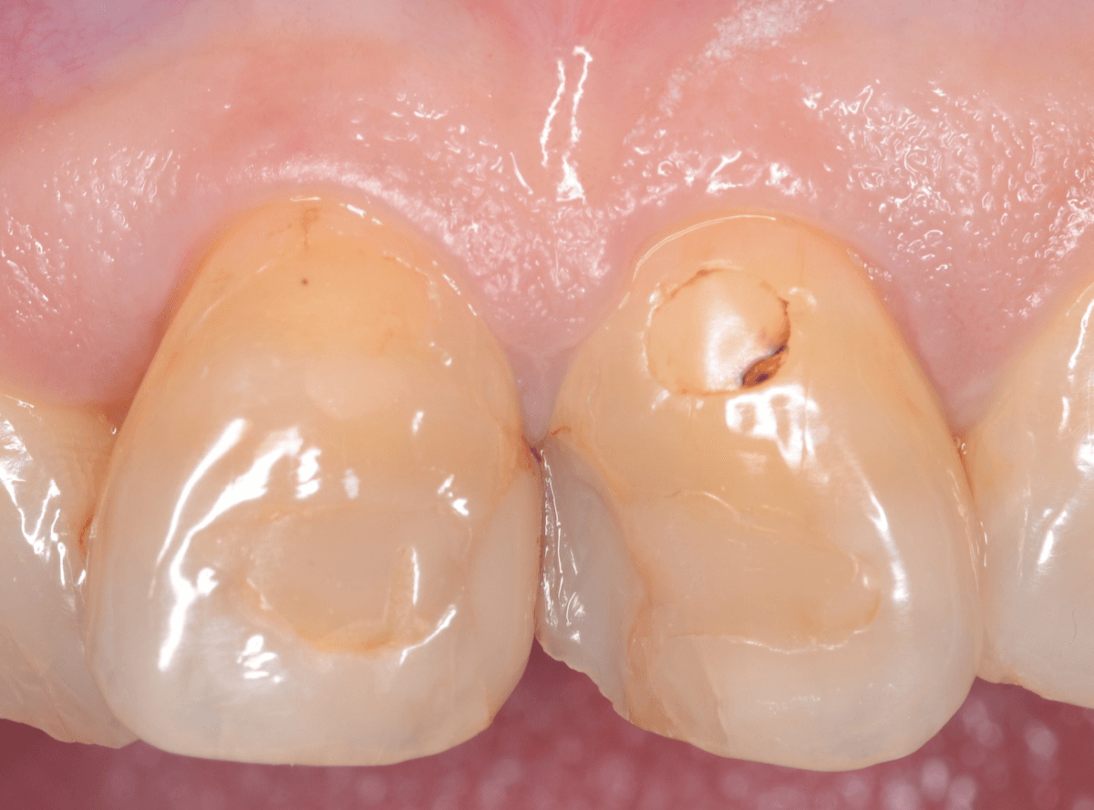 コンポジットレジン治療3-1