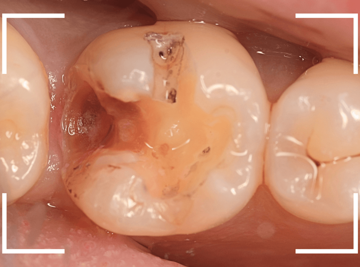つめものの下の深い虫歯(画像)10-1