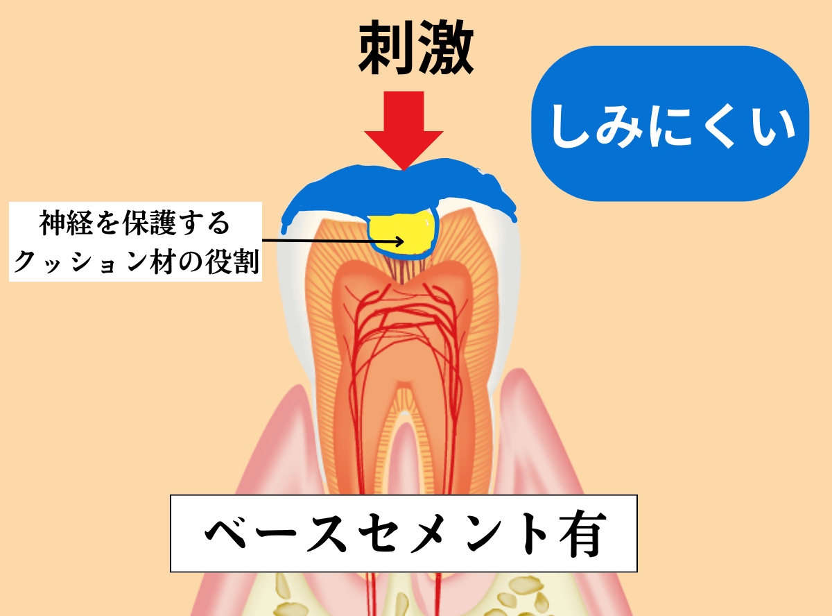 歯の治療の器具_ベースセメント-4
