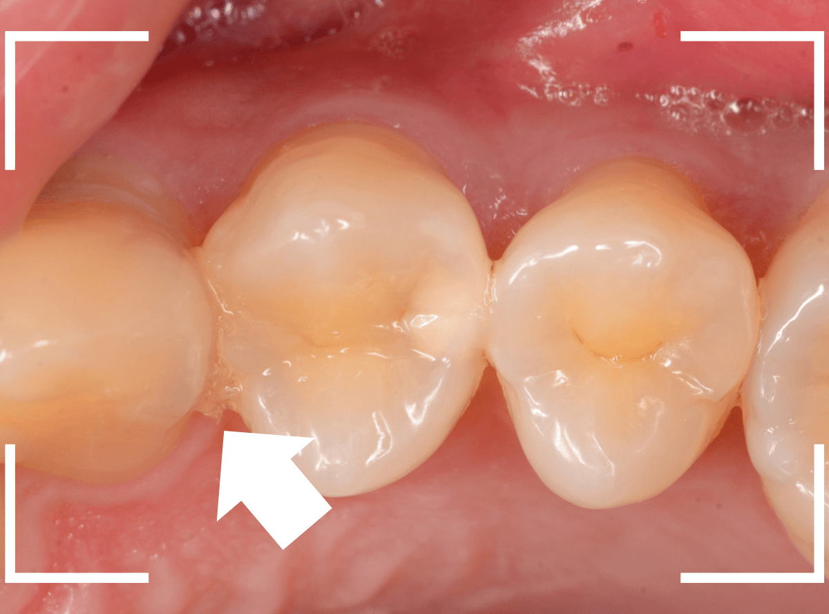 歯と歯の間の虫歯16-3