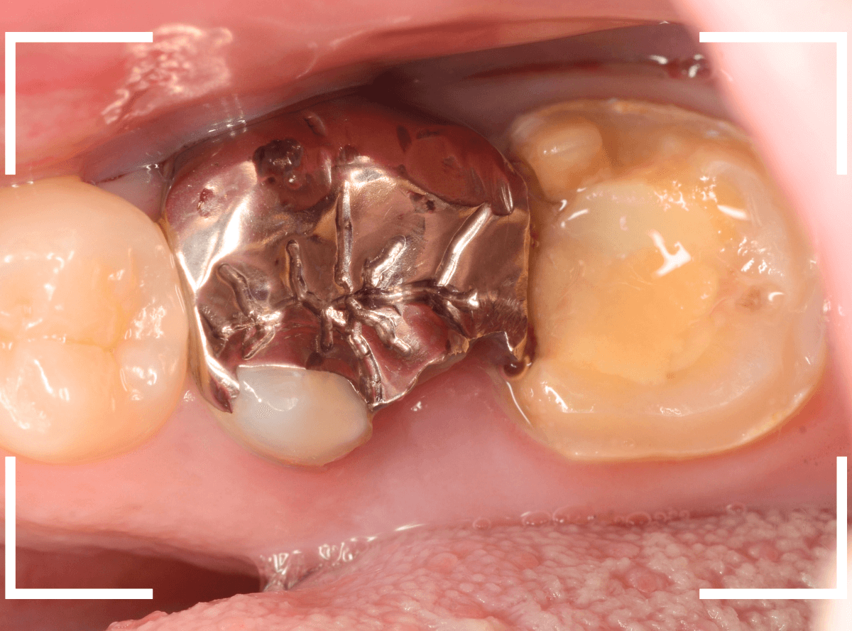 気づかないうちに深い虫歯15-1