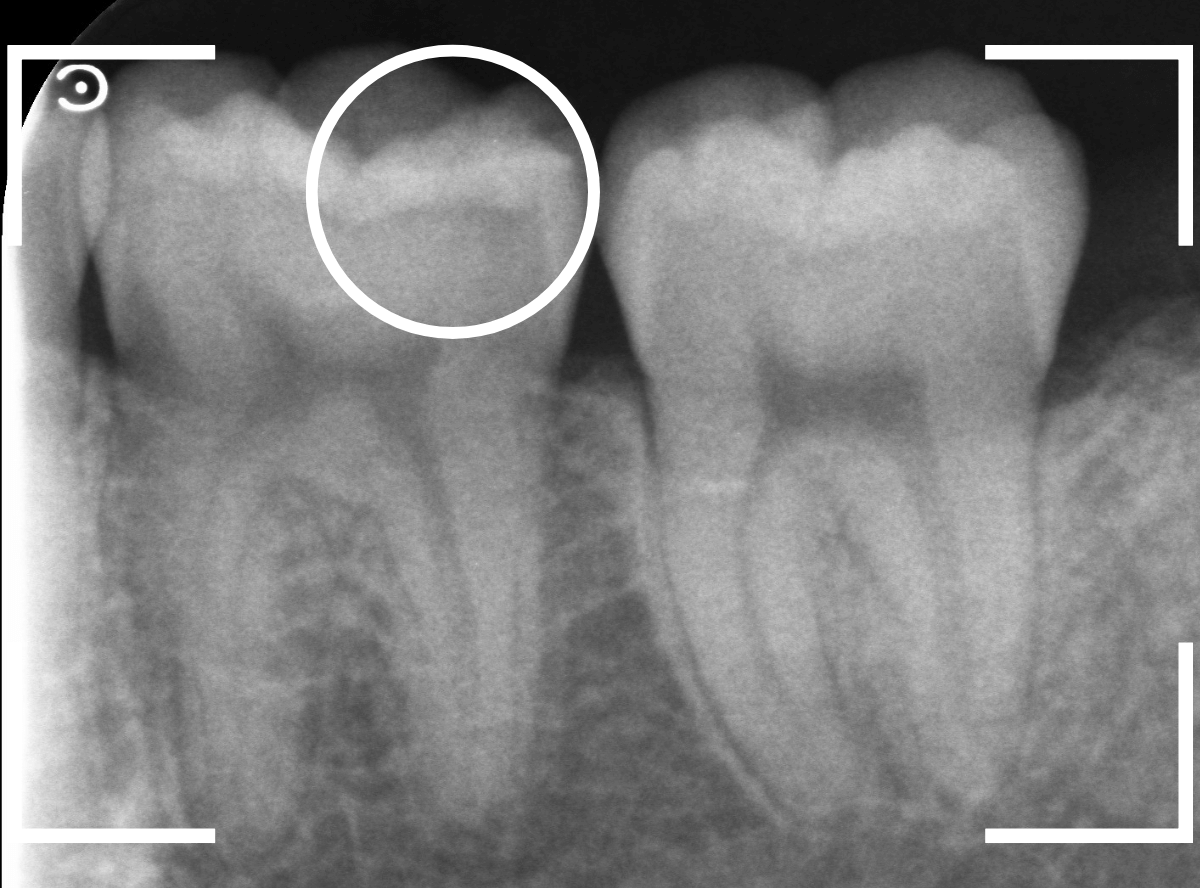 レントゲンでわかりづらい虫歯16-2