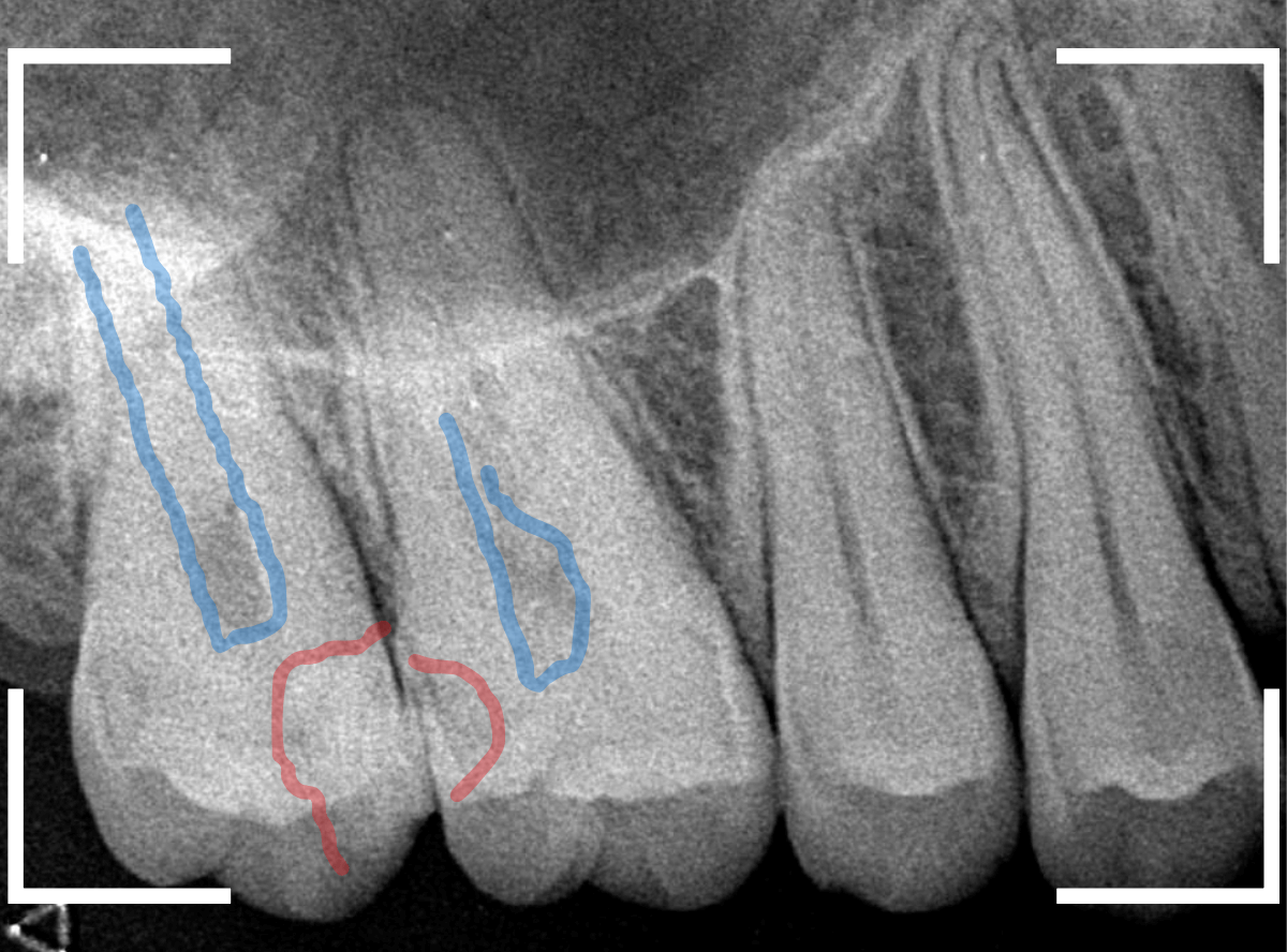 歯と歯の間の虫歯20-2