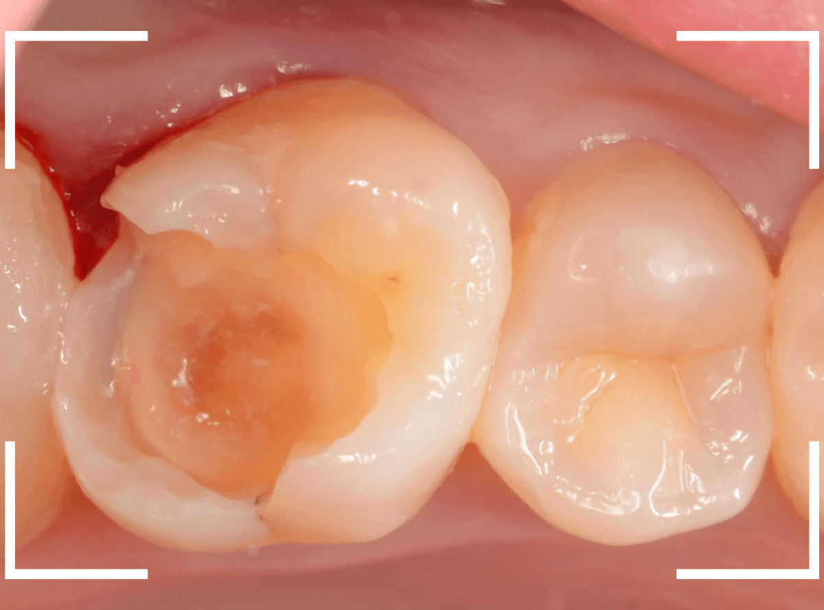 セラミック治療(インレー)32-5