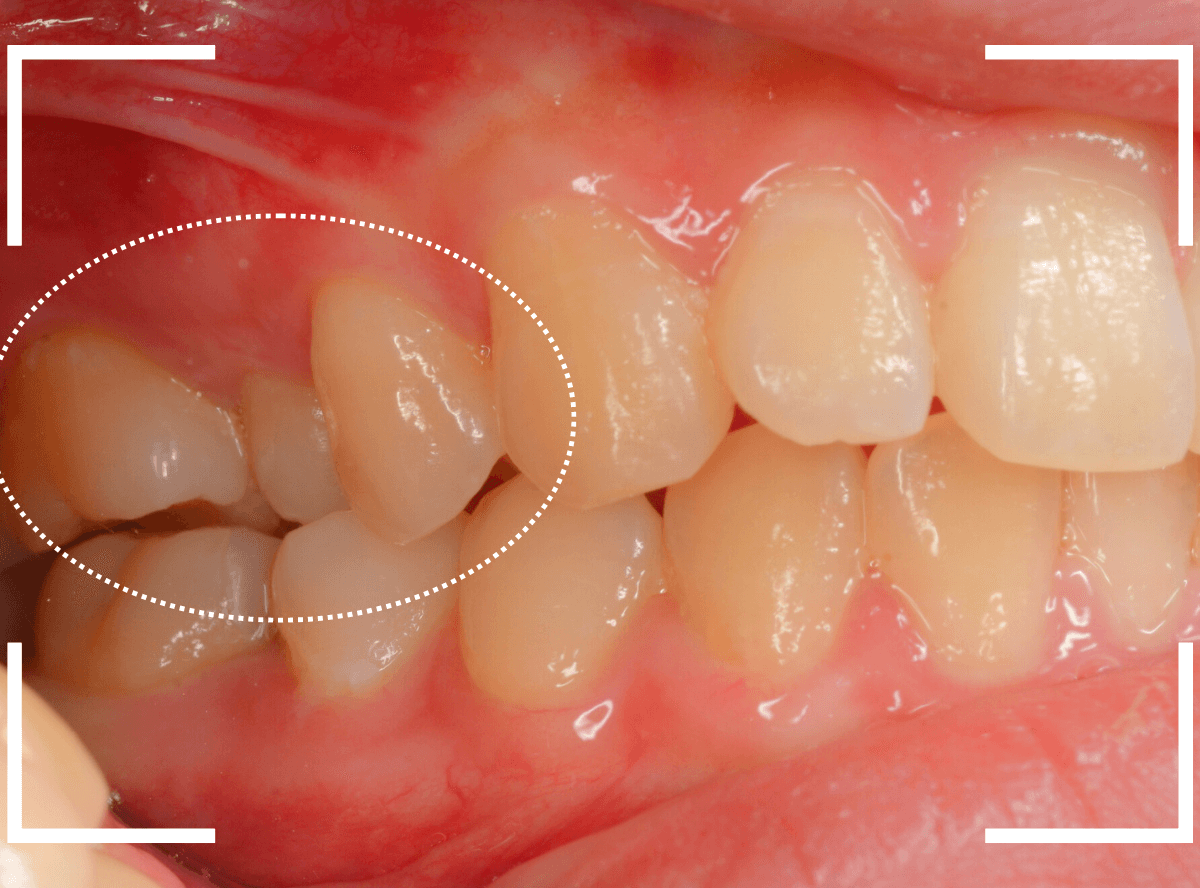 セラミック治療(インレー)32-13