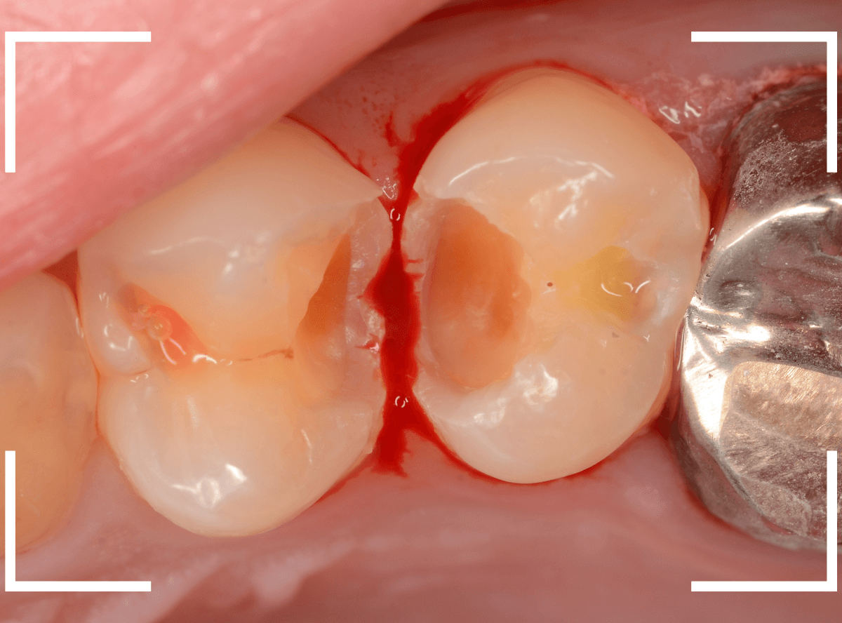 歯と歯の間の虫歯22-5