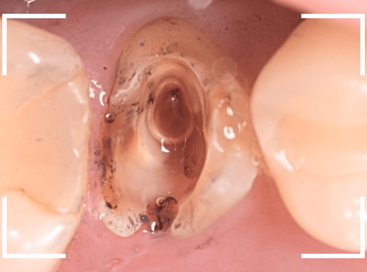 セラミック治療(クラウン・奥歯)8-4