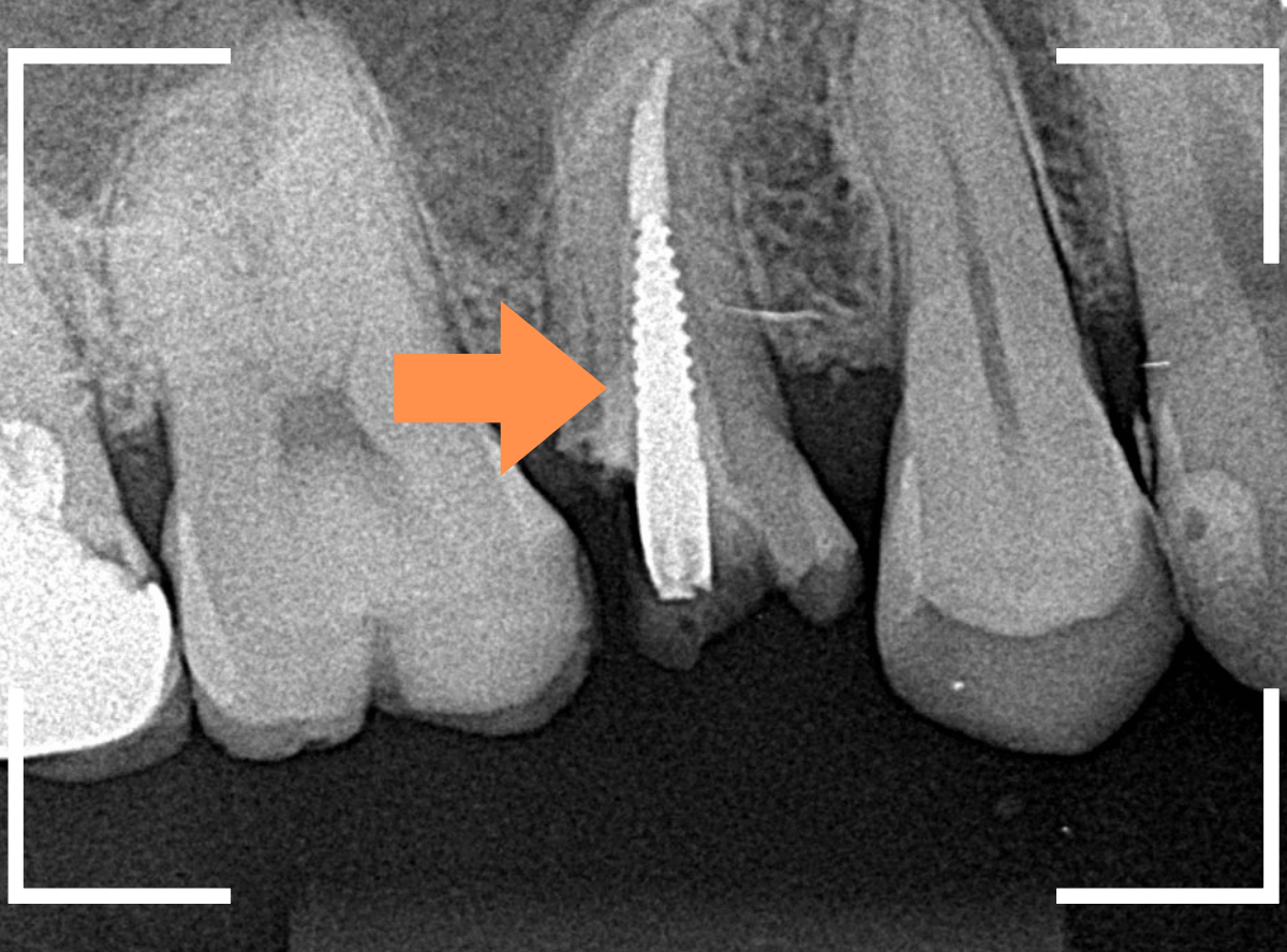 セラミック治療(クラウン・奥歯)8-2