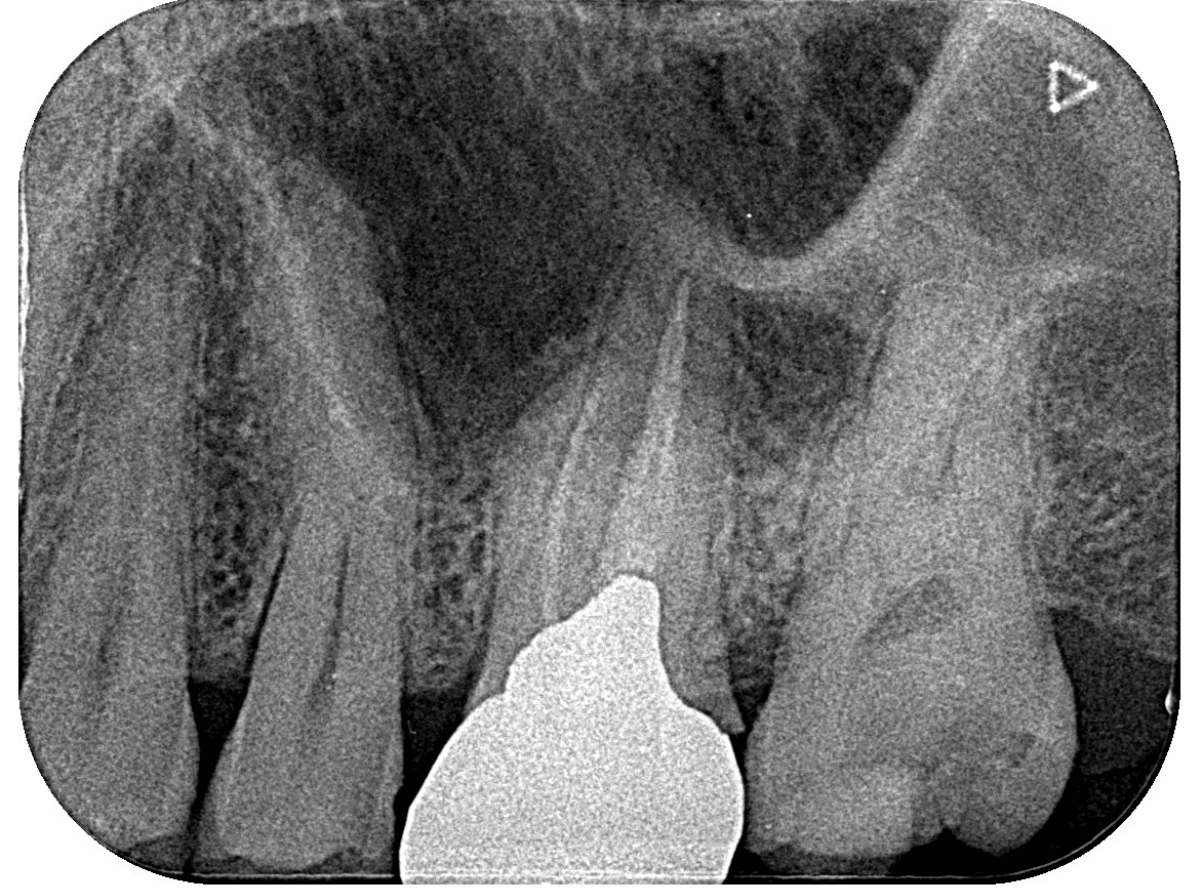 気づかないうちに深い虫歯2-2