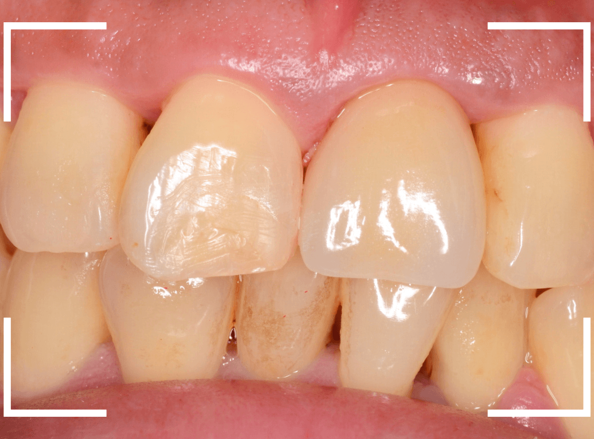 セラミック治療(前歯・クラウン)5-10