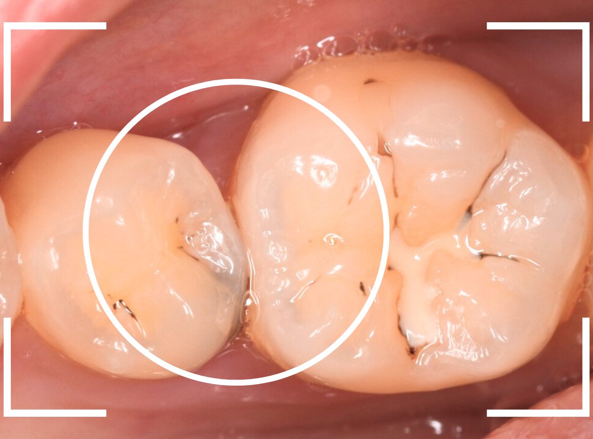 セラミック治療(インレー)23-1