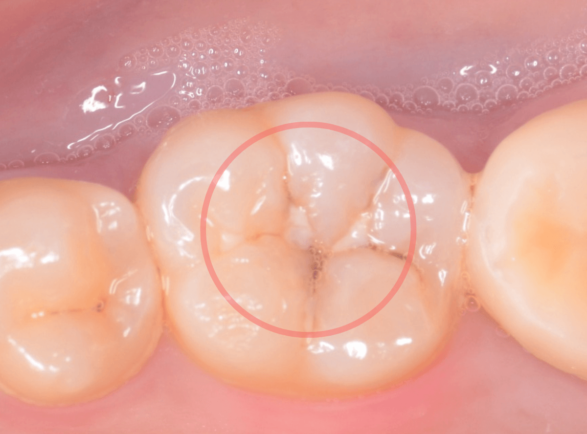 コンポジットレジン治療1-1