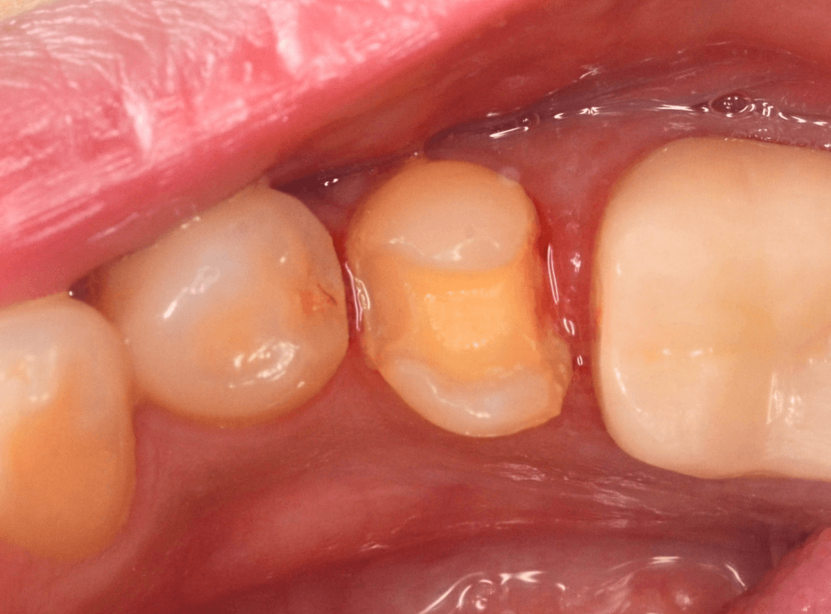 セラミック治療(インレー)5-1