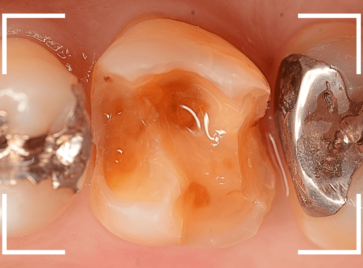 つめものの下の深い虫歯(画像)10-1