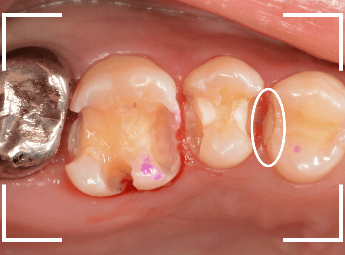 レントゲンでわかりづらい虫歯15-6