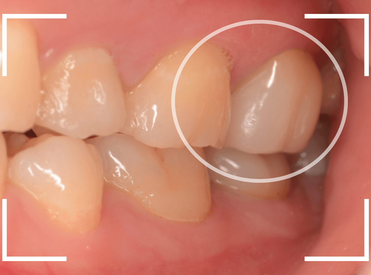メタル・フリー治療の実際21-6
