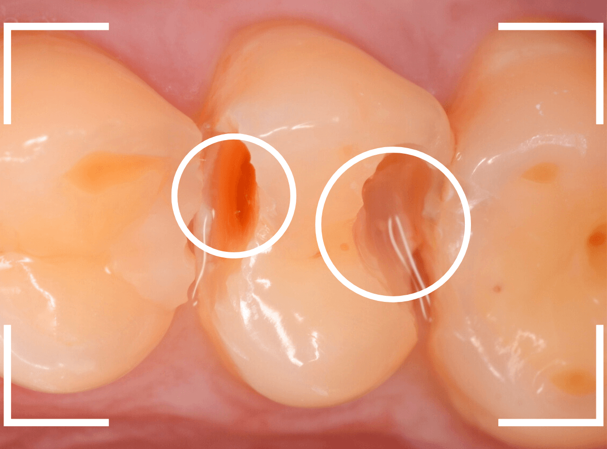 セラミック治療(インレー)24-6