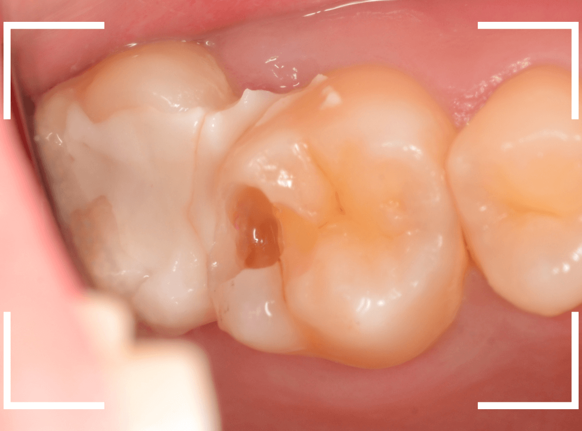 歯と歯の間の虫歯20-6