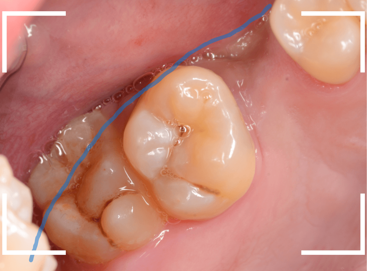 おやしらずの抜歯13-1