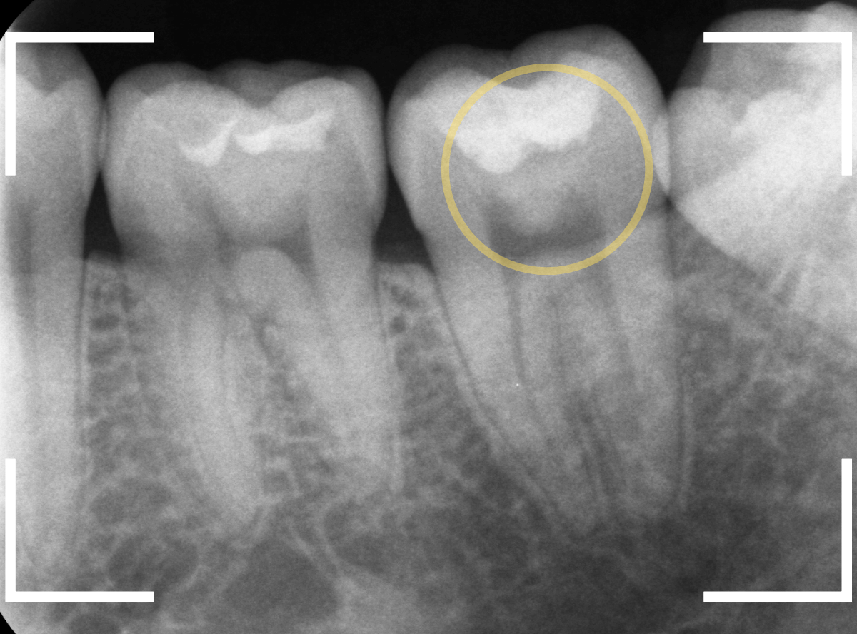 レントゲンでわかりづらい虫歯17-2