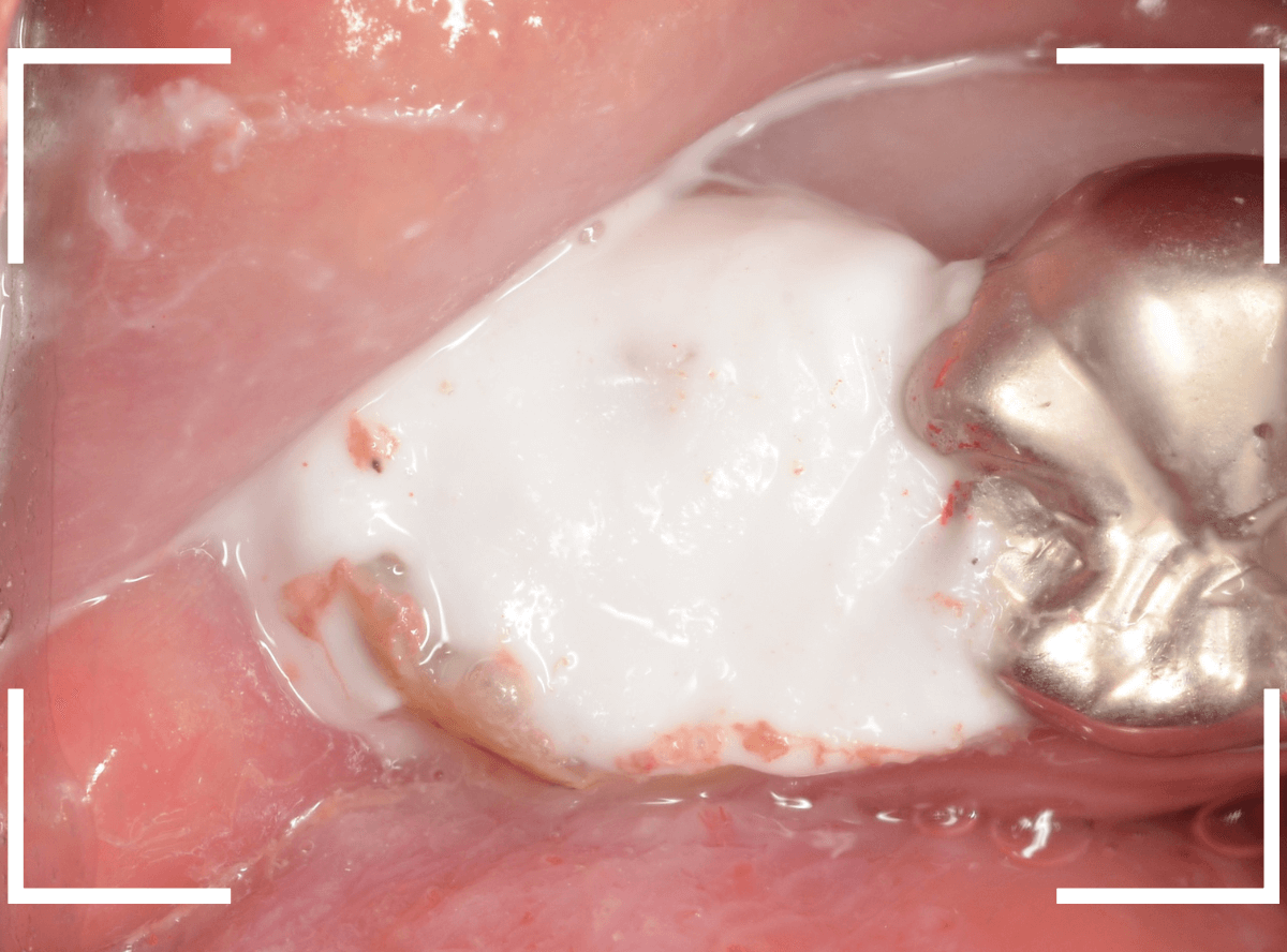 気づかないうちに深い虫歯14-6