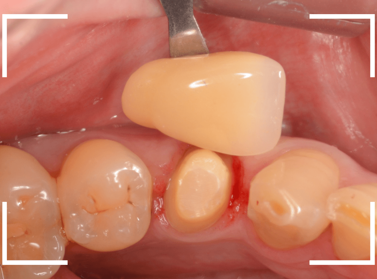 セラミック治療(クラウン・奥歯)11-2