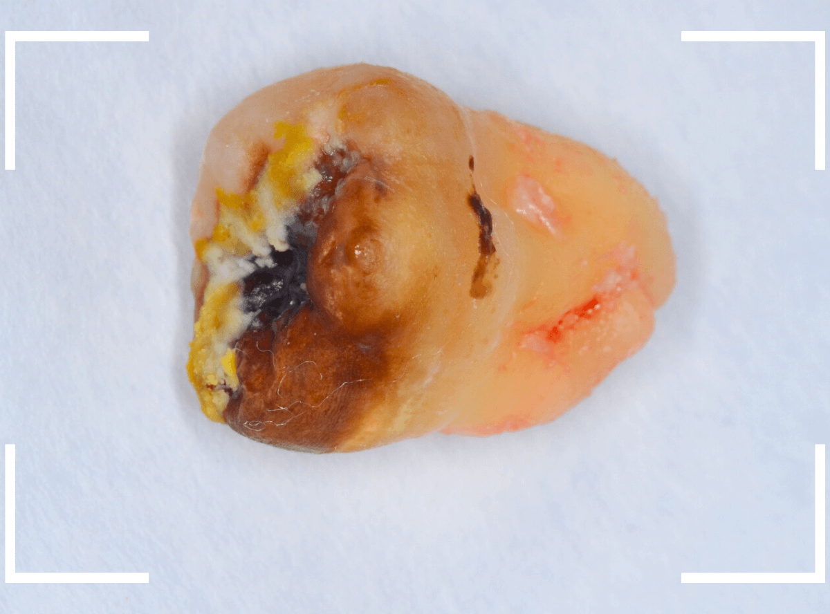 おやしらずの抜歯11-5