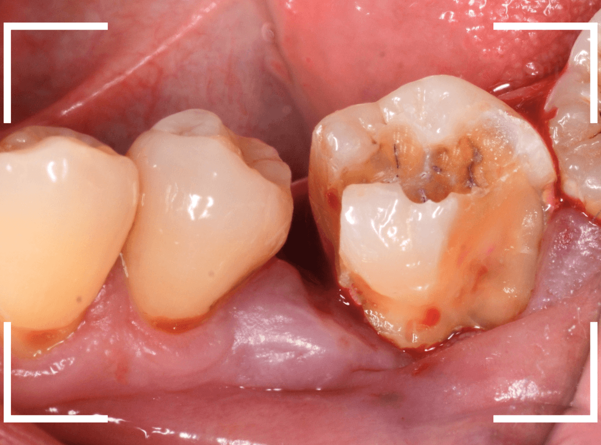 つめものの下の深い深い虫歯12-5