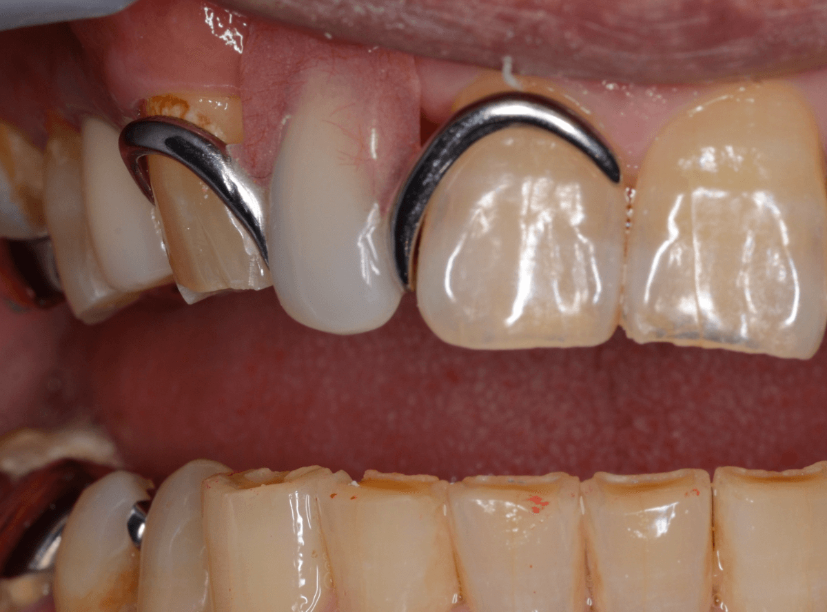 ノンクラスプ・デンチャー画像-3