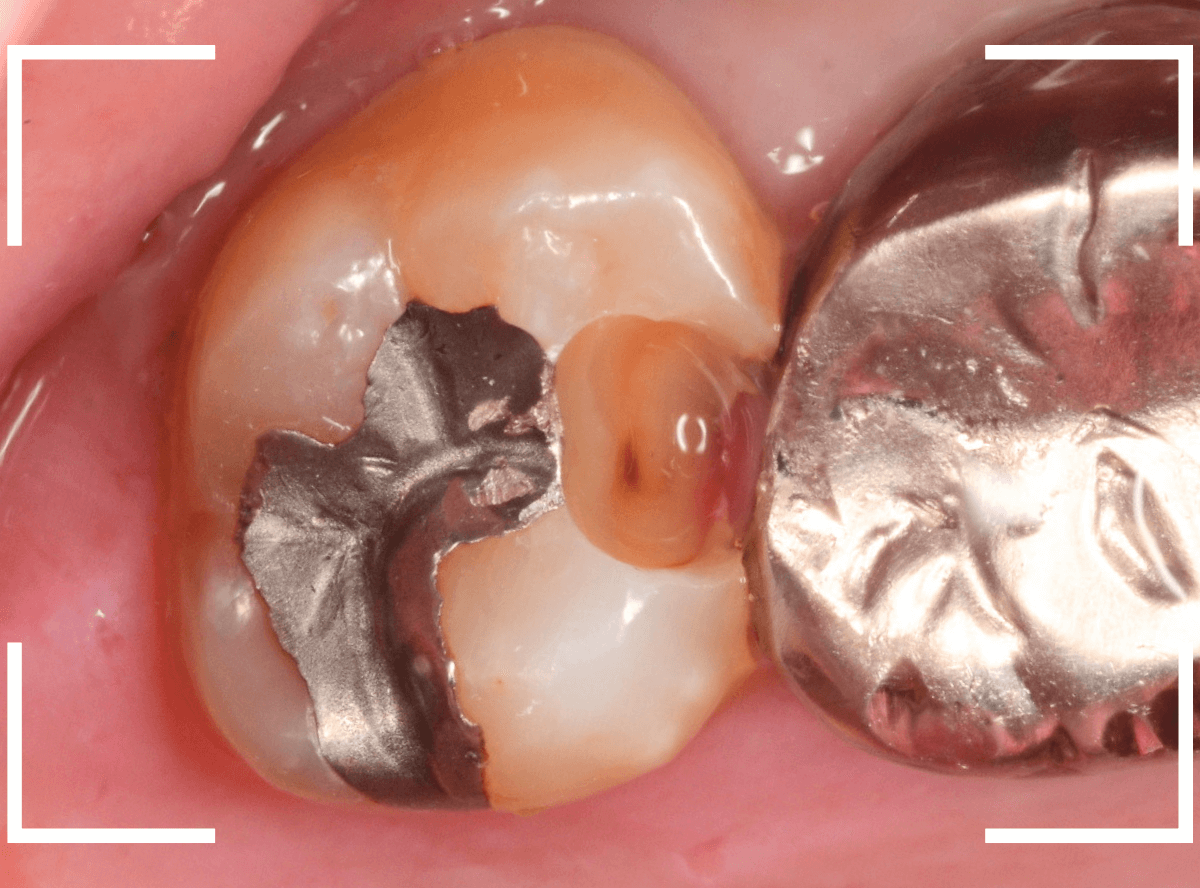 歯と歯の間の虫歯14-4
