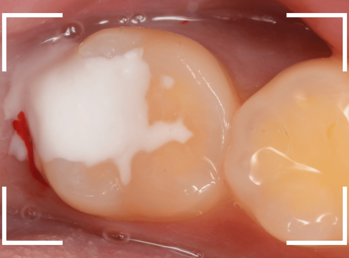 気づかないうちに深い虫歯12-7
