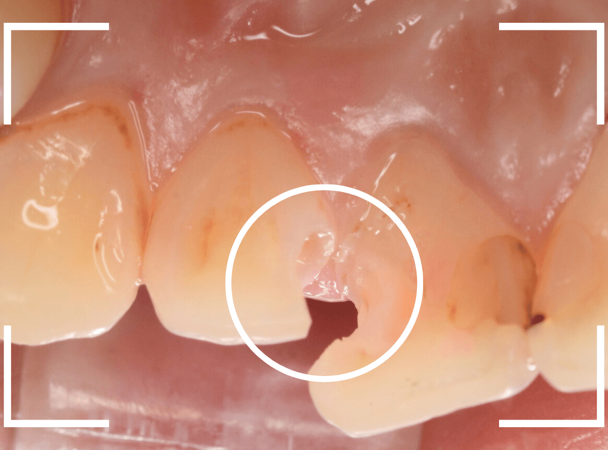 コンポジットレジン治療6-4