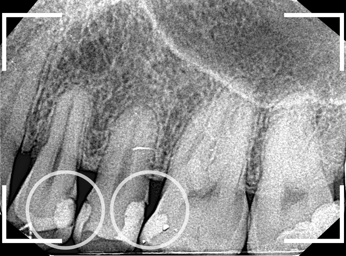 つめものの下の深い深い虫歯17-2