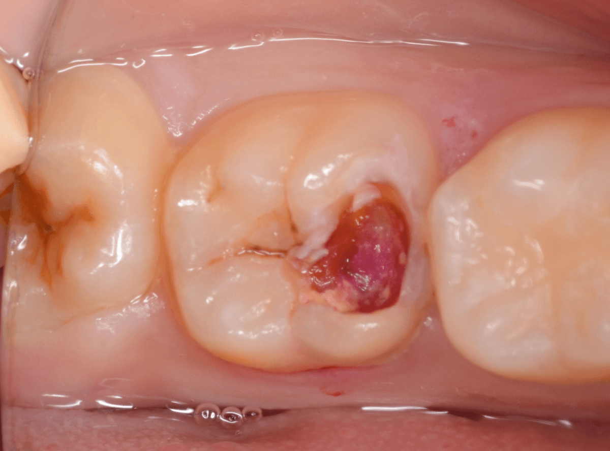 つめものの下の深い深い虫歯11-1