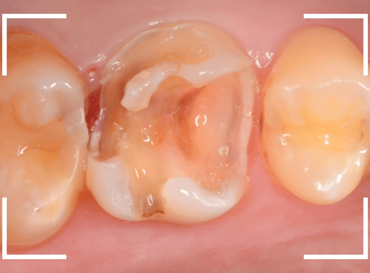 つめものの下の深い虫歯(画像)10-1