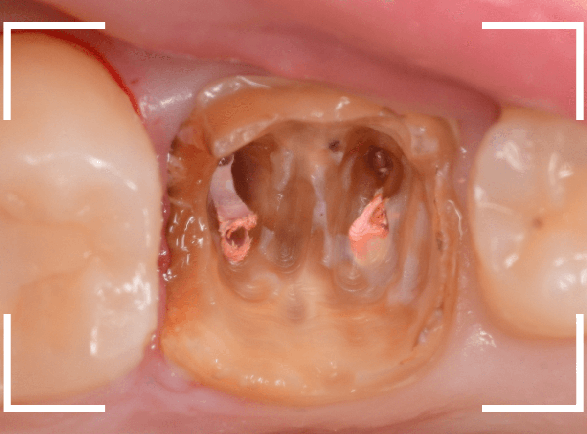 歯の土台の再治療1-4