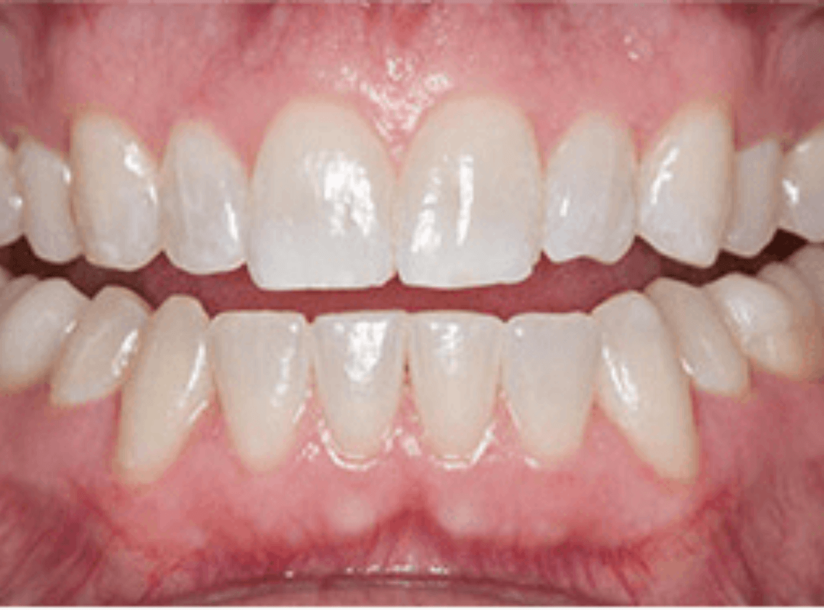 高円寺駅南口徒歩2分の歯医者、高円寺PAL歯科医院のインプラント治療の流れ