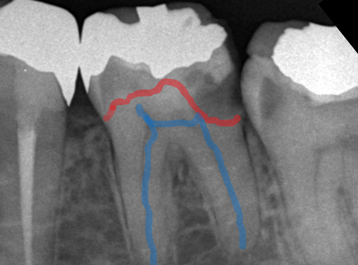 高円寺駅南口徒歩2分の歯医者、高円寺PAL歯科医院の根管治療