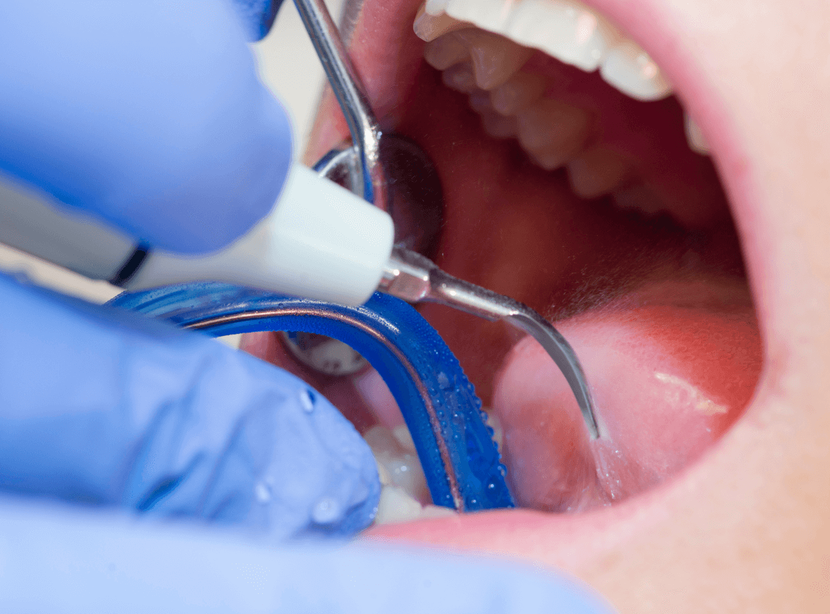 高円寺駅南口徒歩2分の歯医者、高円寺PAL歯科医院の治療後のメンテナンスの流れ