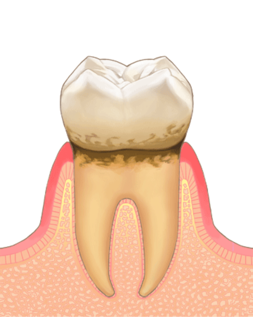 高円寺駅南口徒歩2分の歯医者、高円寺PAL歯科医院の歯周病治療