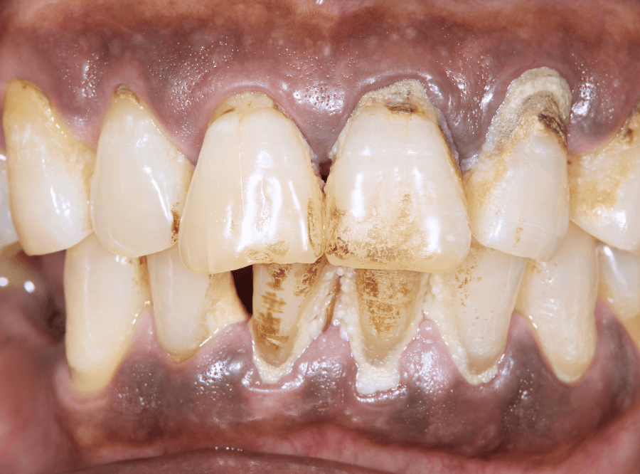 高円寺駅南口徒歩2分の歯医者、高円寺PAL歯科医院の歯周病治療