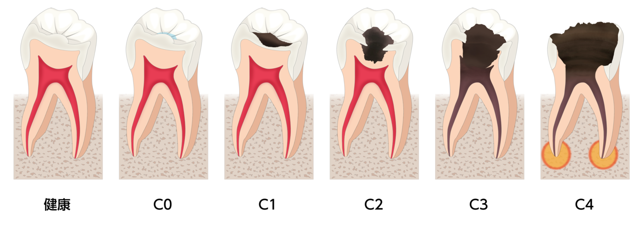 高円寺駅南口徒歩2分の歯医者、高円寺PAL歯科医院のむし歯治療