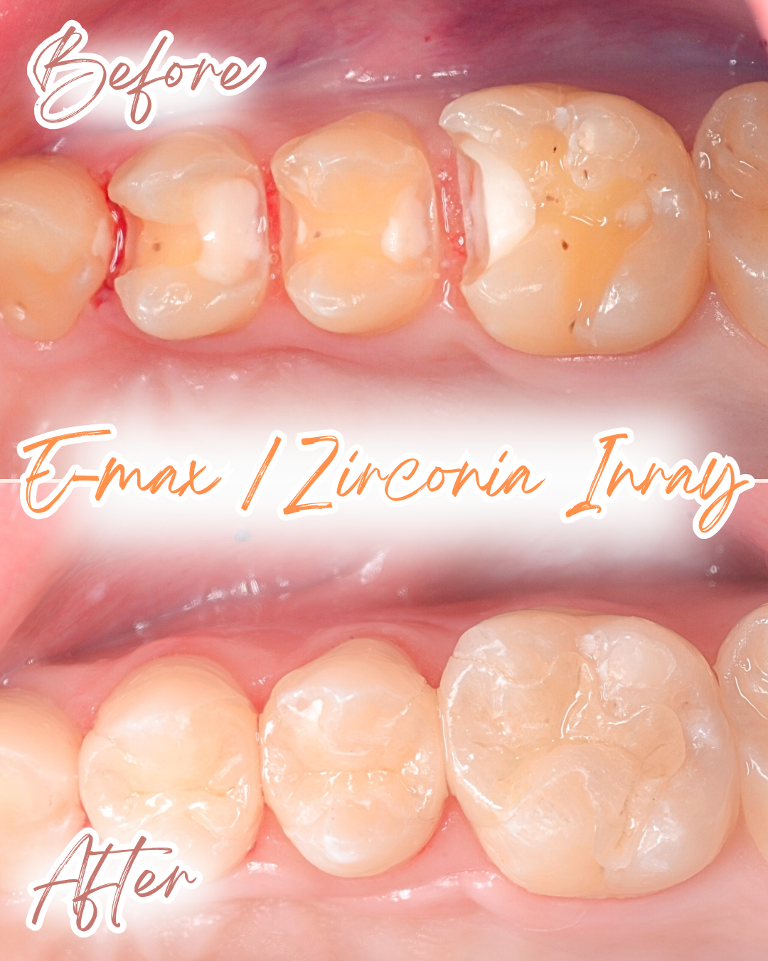 高円寺駅南口徒歩2分の歯医者、高円寺PAL歯科医院のセラミック治療