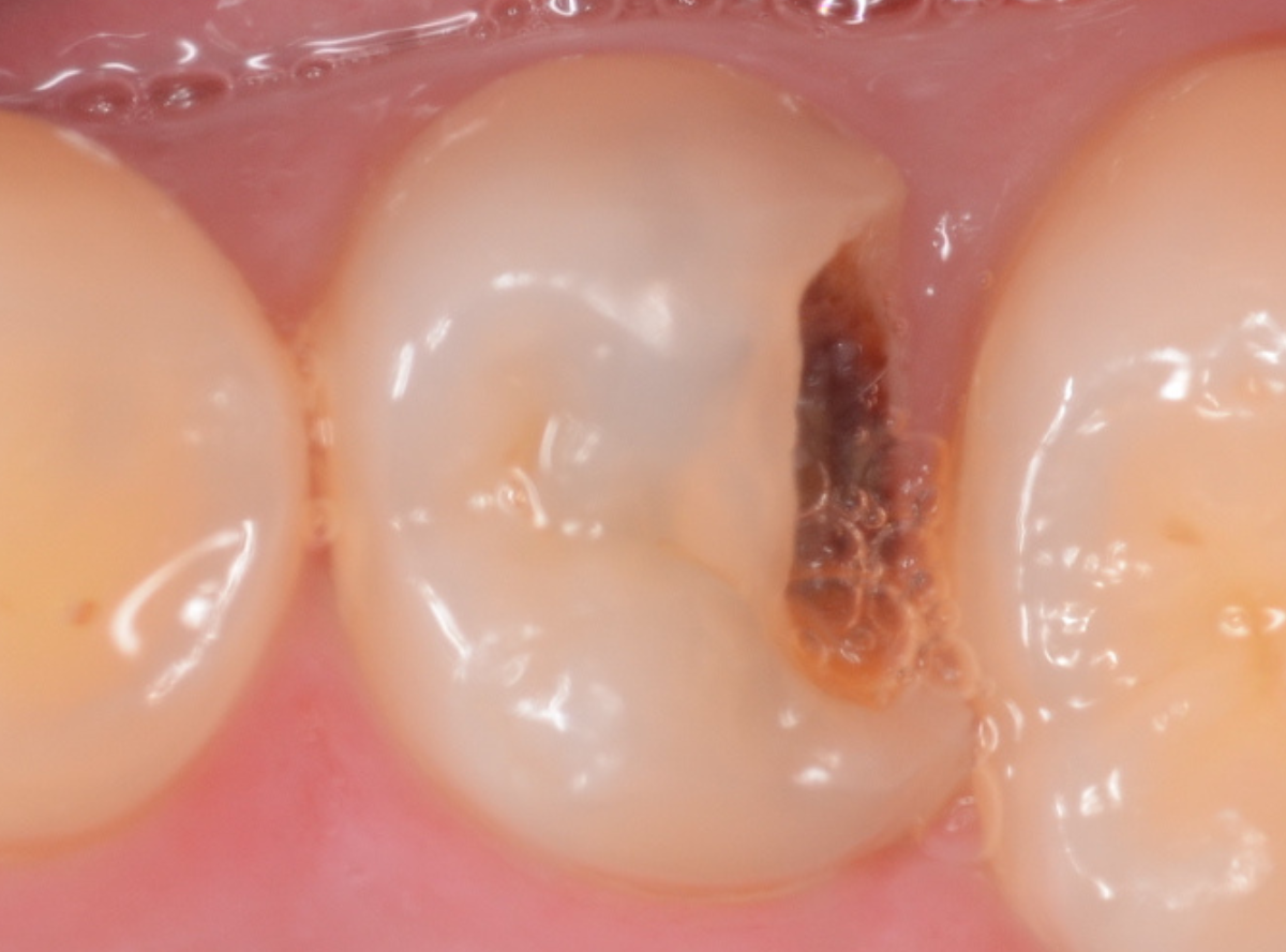 高円寺駅南口徒歩2分の歯医者、高円寺PAL歯科医院の歯を残す治療