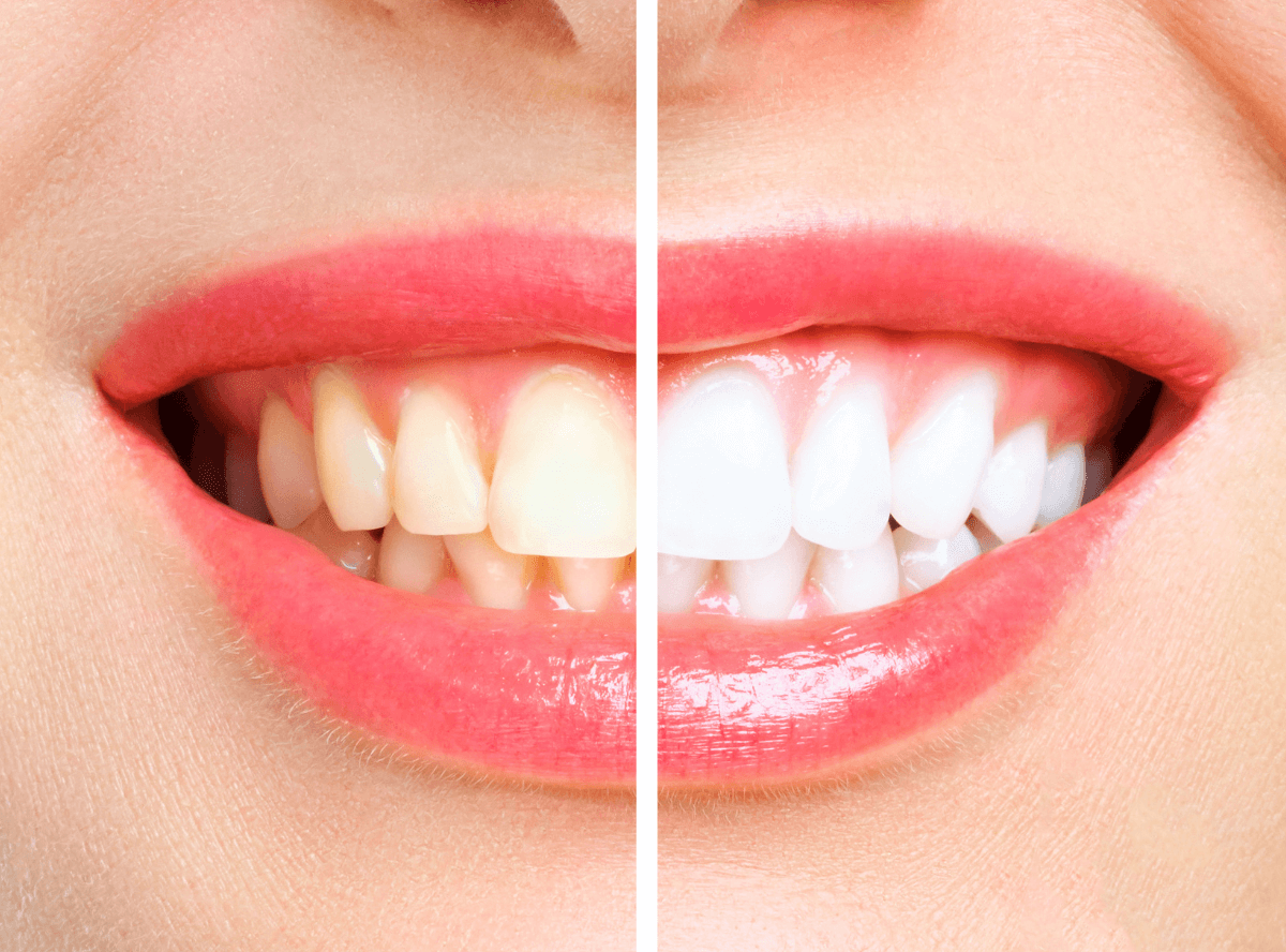 高円寺駅南口徒歩2分の歯医者、高円寺PAL歯科医院のホワイトニング