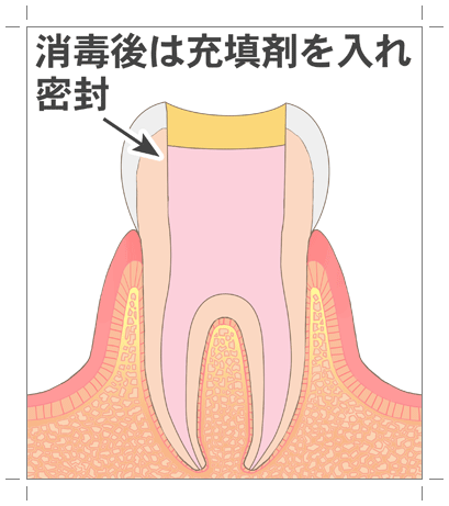 高円寺駅南口徒歩2分の歯医者、高円寺PAL歯科医院の根管治療の流れ