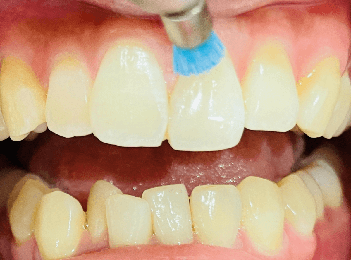 高円寺駅南口徒歩2分の歯医者、高円寺PAL歯科医院のホワイトニング