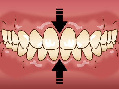 高円寺駅南口徒歩2分の歯医者、高円寺PAL歯科医院の歯ぎしり・食いしばり治療