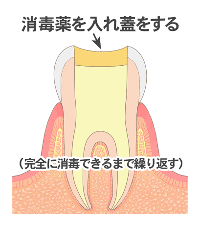 高円寺駅南口徒歩2分の歯医者、高円寺PAL歯科医院の根管治療の流れ