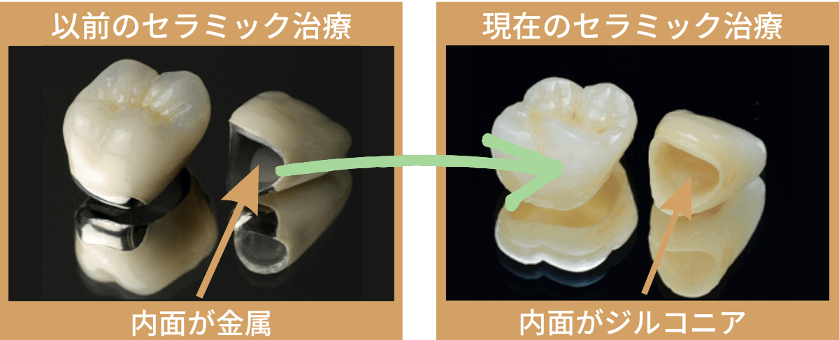 高円寺駅南口徒歩2分の歯医者、高円寺PAL歯科医院のセラミック治療